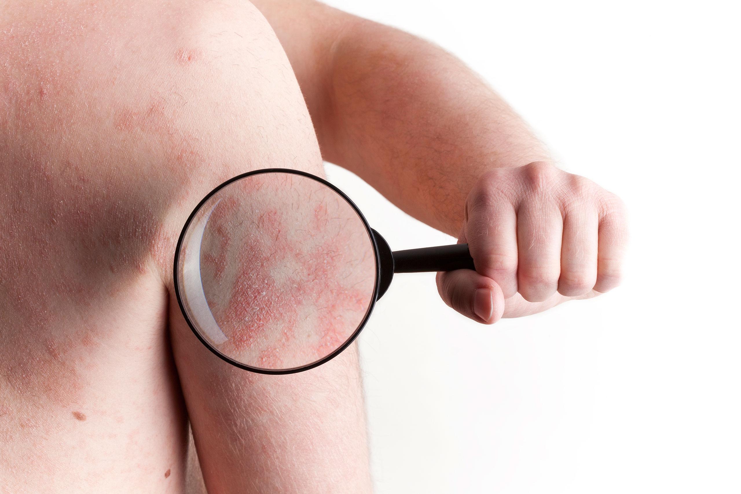 eczema-skin-with-magnifying-glass-1